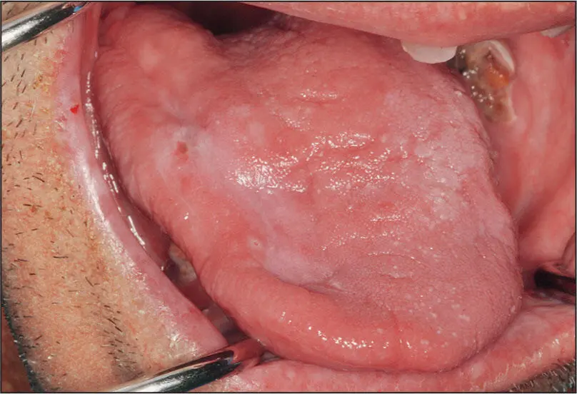 Chronic radiation mucositis Acute and Chronic Radiation Mucositis Nature of - фото 51