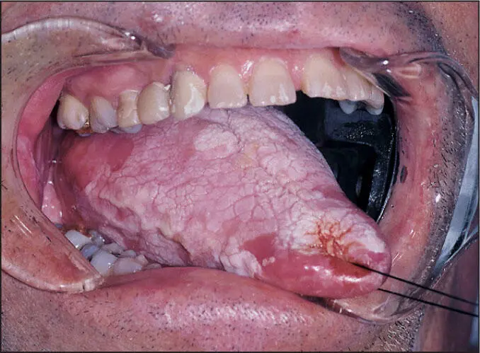 Hypertrophic candidiasis Microscopic features Candida are nonseptate hyphae - фото 45