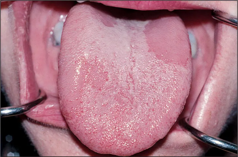 Benign migratory glossitis Benign Migratory Glossitis Nature of disease An - фото 47