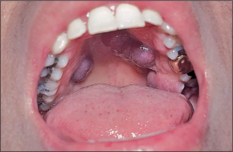AIDSrelated Kaposi sarcoma Kaposi Sarcoma Nature of disease A lowgrade - фото 59