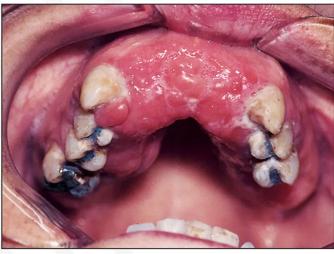 Inflammatory hyperplasia - фото 41
