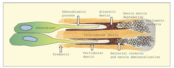 Fig 216In a caries lesion cariogenic bacteria invade the dentinal tubules - фото 54