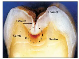 Fig 324Mineralized tooth sectioned in half to reveal caries in the enamel - фото 82