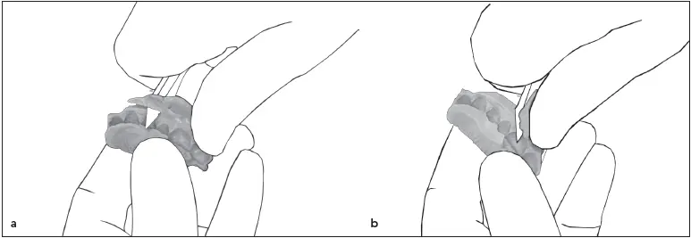 Fig 411 a and b Registration material extending gingival to the occlusal - фото 63