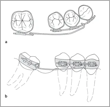 Fig 728Orthodontic appliance for uprighting a tilted molar a occlusal - фото 197