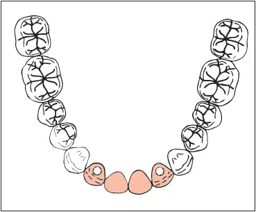 Missing Maxillary first and second premolars and first molar Abutments Canine - фото 266