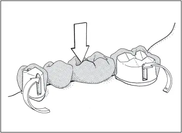 Fig 718The walls of facial and lingual grooves counteract mesiodistal torque - фото 187