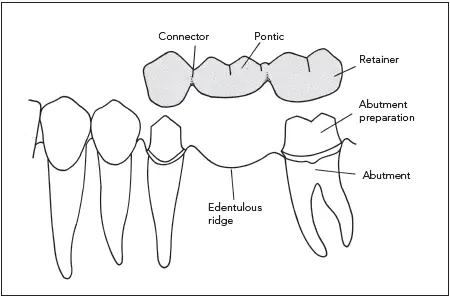 Fig 16The components of a fixed partial denture Medications The patient - фото 9