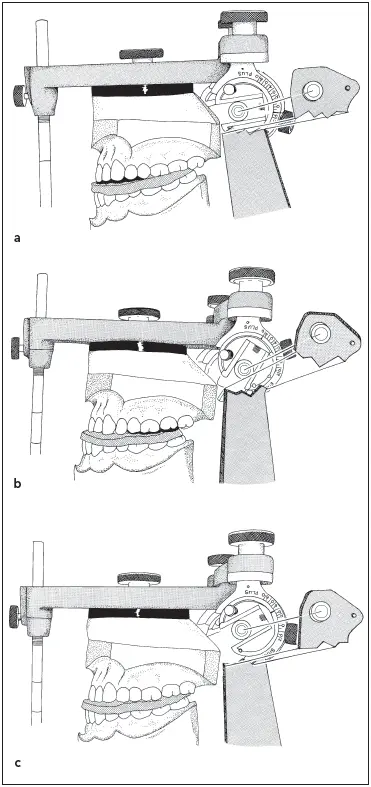 Fig 568When using a protrusive interocclusal record to set the condylar - фото 145
