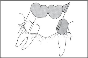 Fig 731A nonrigid connector on the distal aspect of the premolar retainer - фото 200