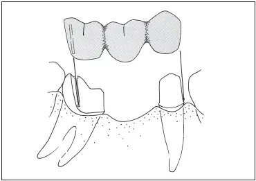 Fig 729Fixed partial denture using a proximal half crown as a retainer on a - фото 198