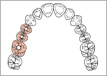 Missing Maxillary first and second premolars and first molar Implants 40 - фото 268