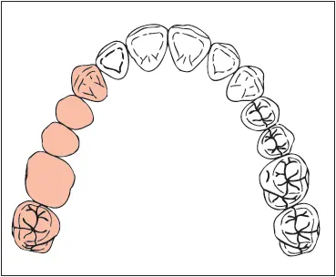 Missing Maxillary first and second premolars and first molar Implants 40 - фото 267