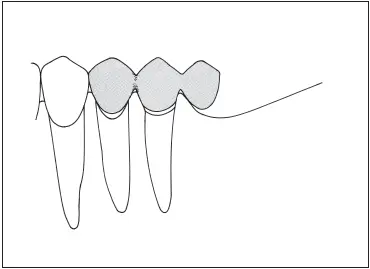 Fig 739Cantilever fixed partial denture replacing a mandibular first molar - фото 208