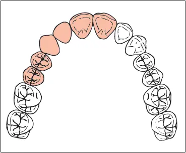 Missing Maxillary lateral incisor and canine Implants 35 12 mm lateral - фото 253