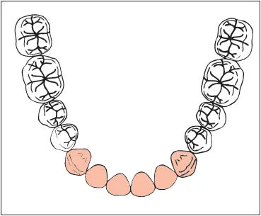 Missing All mandibular incisors Implants 40 12 mm lateral incisors - фото 265