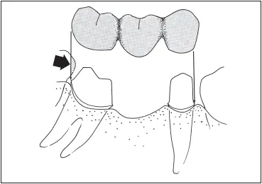 Fig 727This fixed partial denture will not seat because the tooth distal to - фото 196