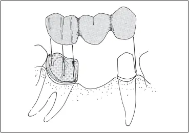 Fig 730Fixed partial denture using a telescope crown and coping as a retainer - фото 199
