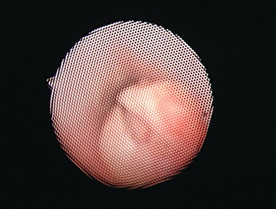 Figure 18 An image through a coherent fiber bundle of a flexible fiberoptic - фото 13