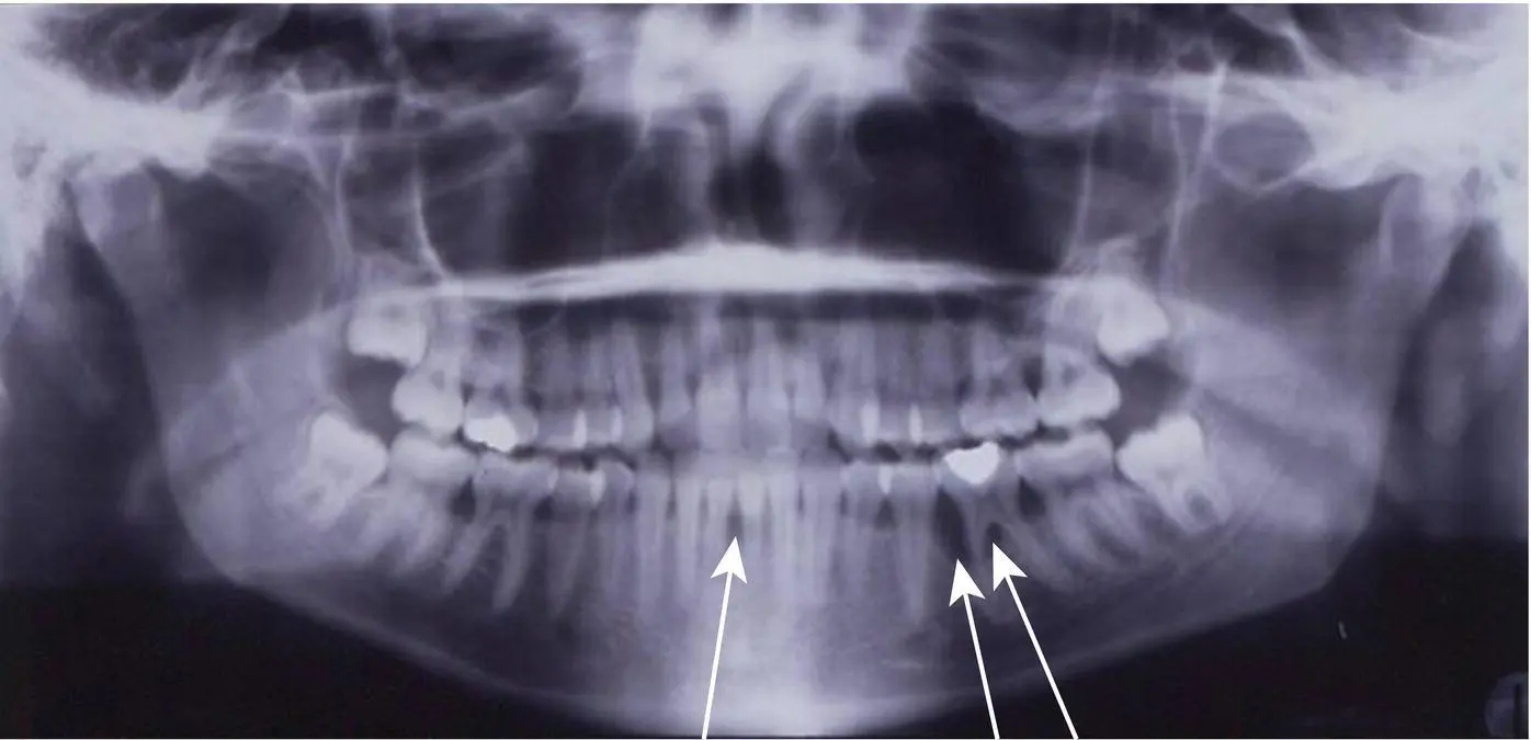 Figure 46 25yearold woman localised periodontitis stage III severe - фото 29