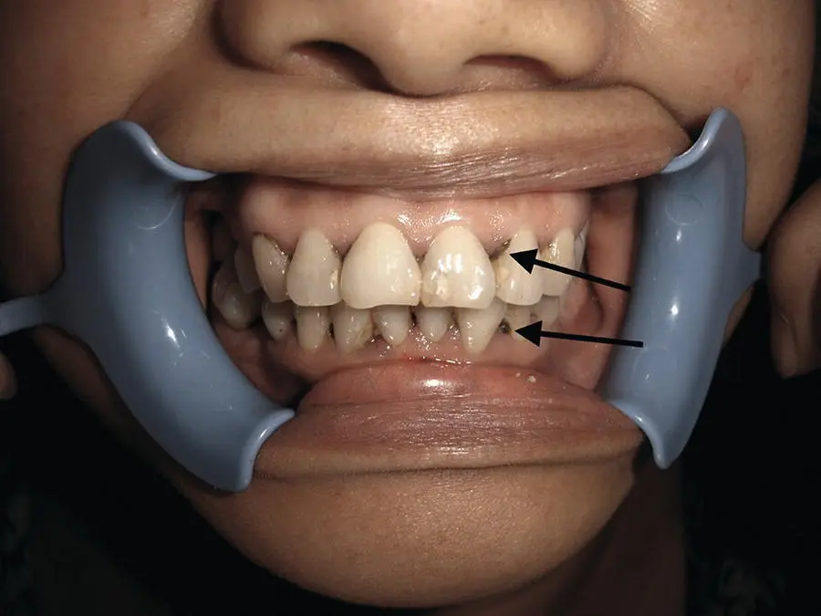 Figure 25 Subgingival calculus exposed after improved oral hygiene Source - фото 19