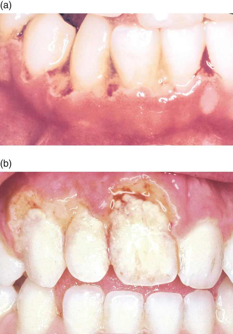 Figure 47 abNecrotising ulcerative gingivitis Source 7 Reproduced with - фото 30