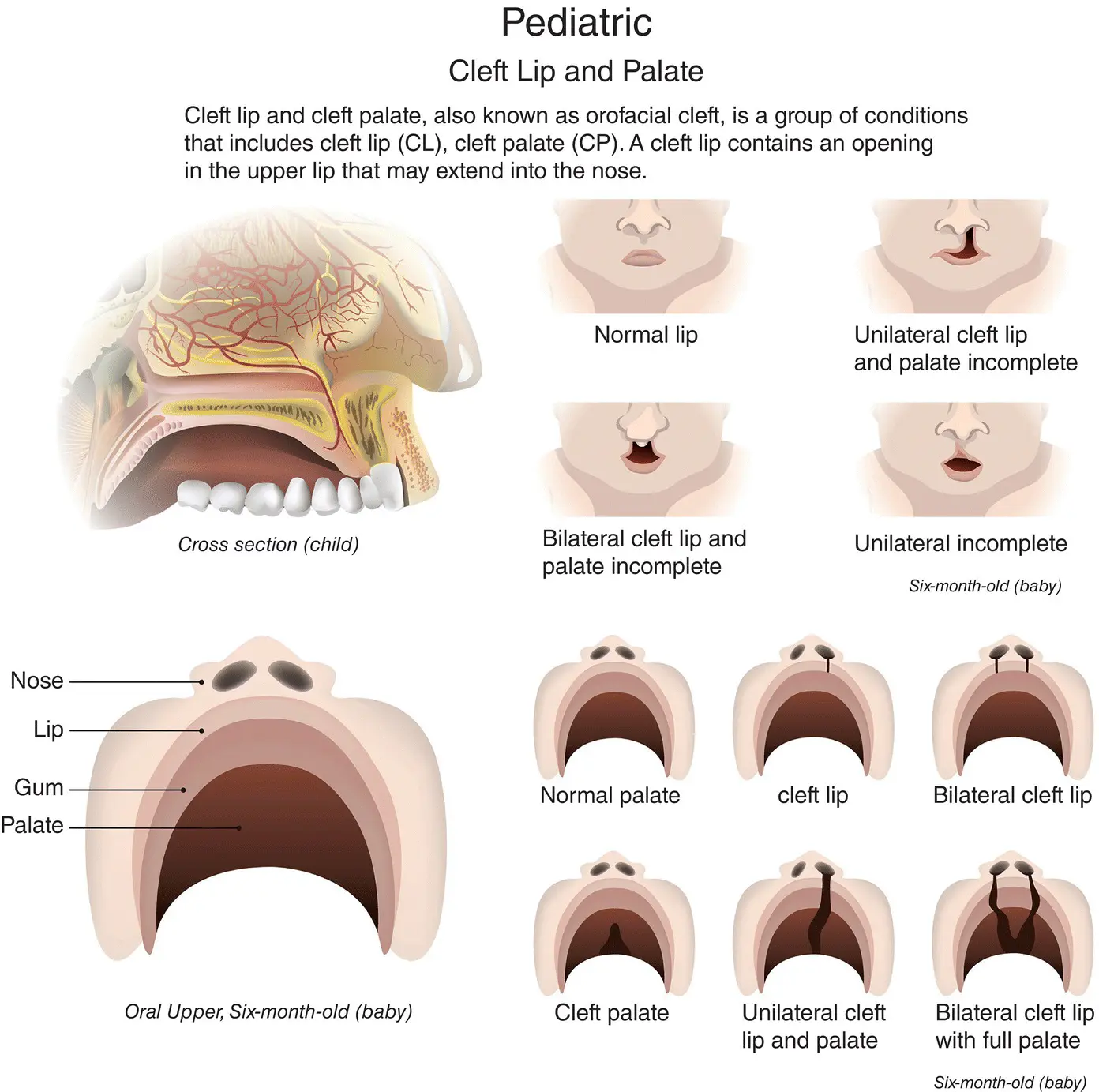 Figure 16 Cleft lip and palate in a sixmonthold baby Source - фото 10