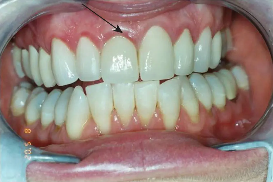 Figure 31 Localised marginal gingivitis Source Professor Nicola West - фото 21