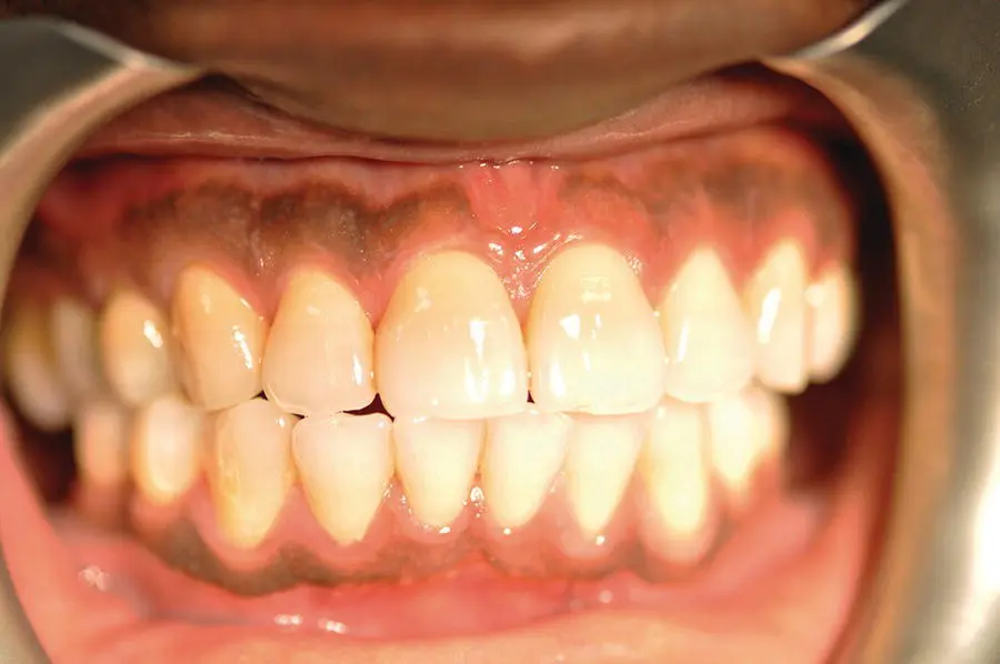 Figure 13 A healthy mouth black person Source Alison Chapman Figure - фото 7