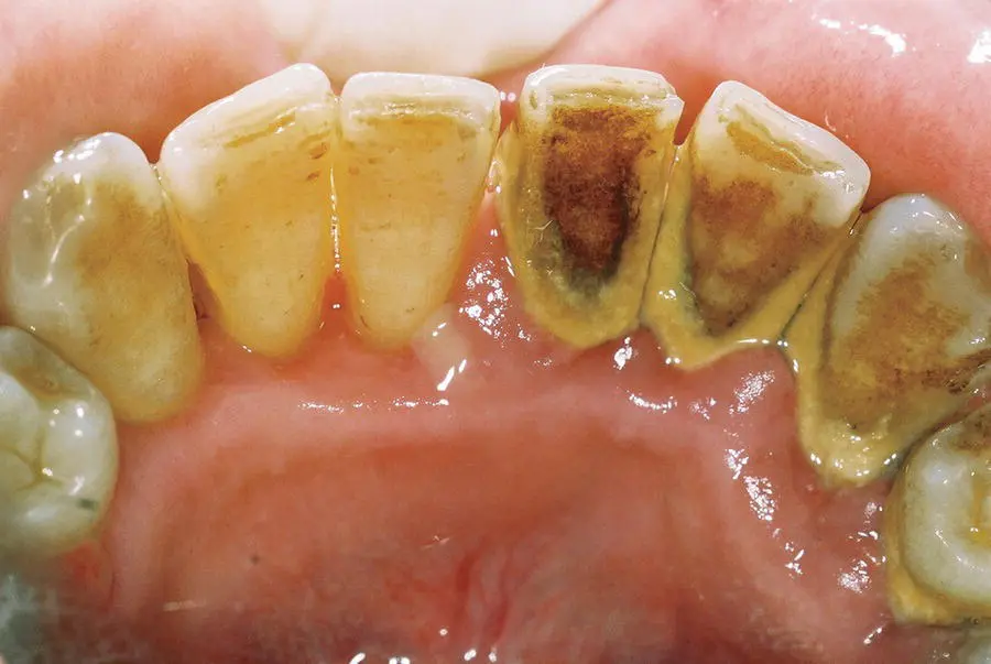 Figure 24 Supragingival calculus before right and after left scaling - фото 18