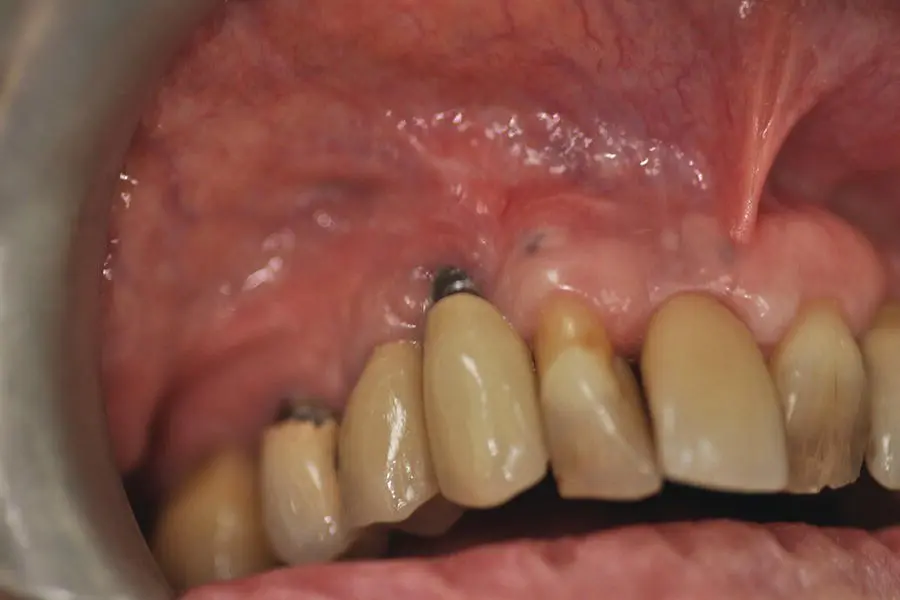 Figure 48 Periimplantitis Source Alison Chapman Figure 49 - фото 31