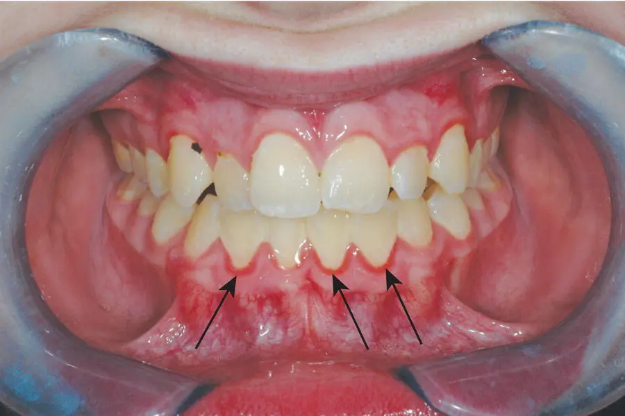 Figure 32 Generalised marginal gingivitis Source Alison Chapman Figure - фото 22