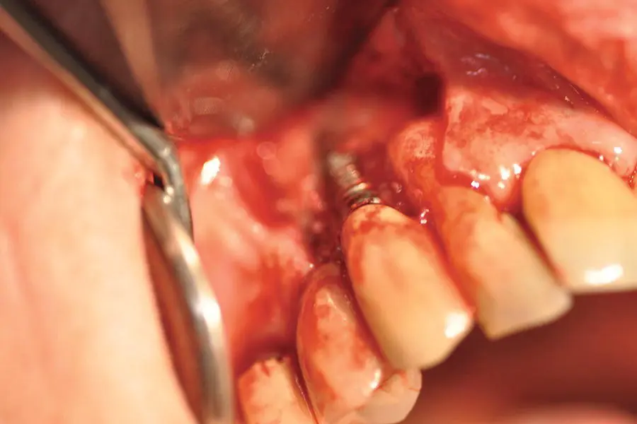 Figure 49 Periimplantitis surgically exposed Source Alison Chapman - фото 32