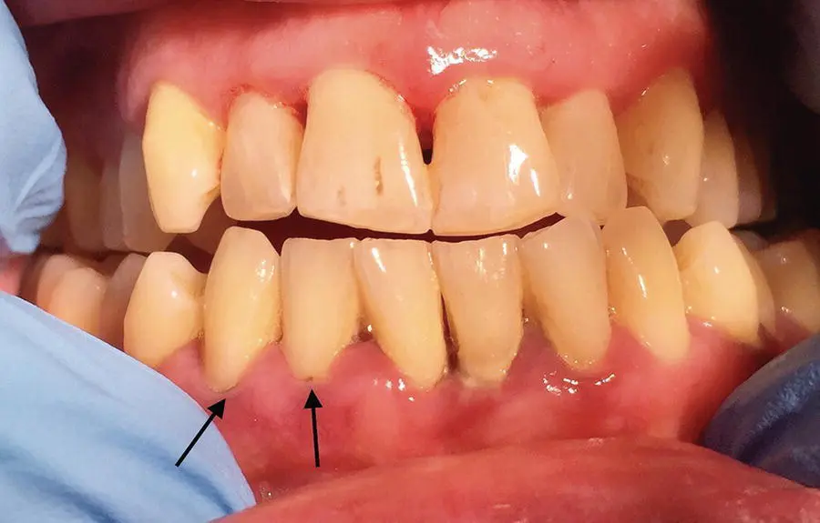 Figure 41 Adult periodontal disease Source Alison Chapman Who does it - фото 24