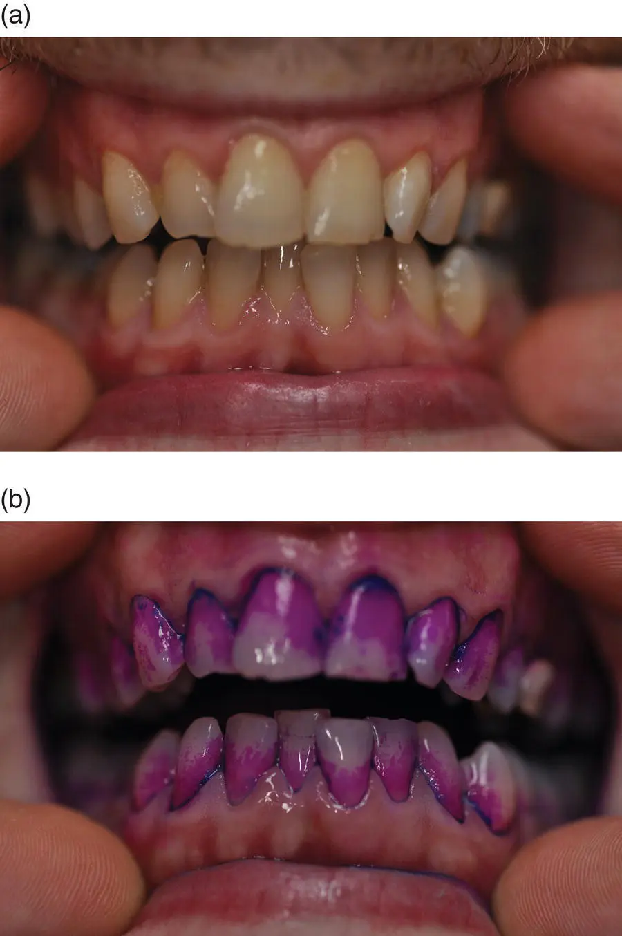 Figure 21 abPlaque undisclosed a disclosed b in the same mouth Source - фото 15