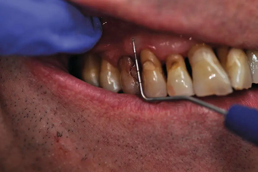 Figure 44 True pocketing Source Alison Chapman Symptoms of periodontitis - фото 27