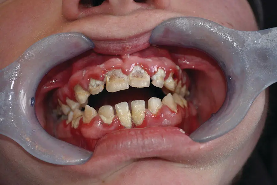 Figure 22 Mature plaque and gingivitis in a neglected mouth Source Alison - фото 16