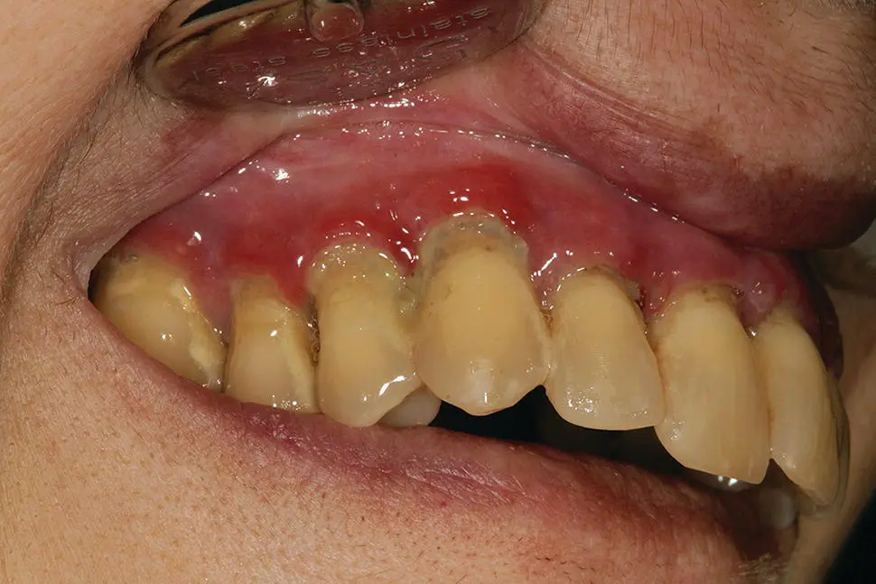 Figure 46 CO A 67yearold woman was presented with multiple bullae on her - фото 51