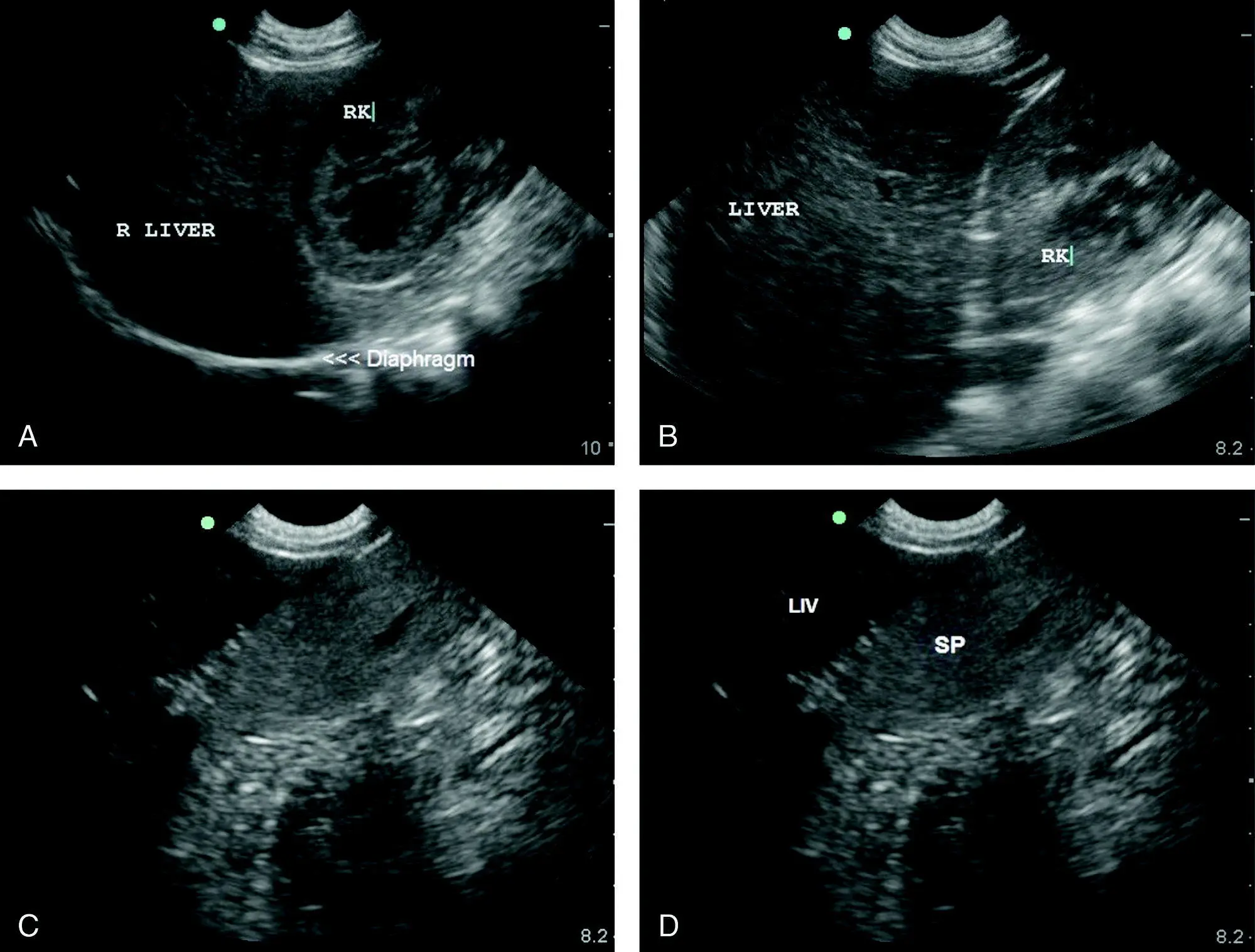 Figure 81 Comparative echogenicity of the liver to the cortex of the right - фото 94