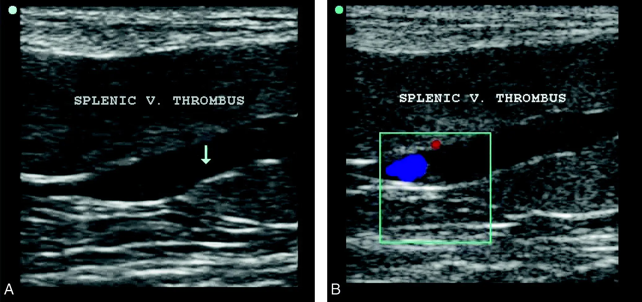 Figure 917 Splenic thrombus A The splenic vein near the hilus appearing - фото 114