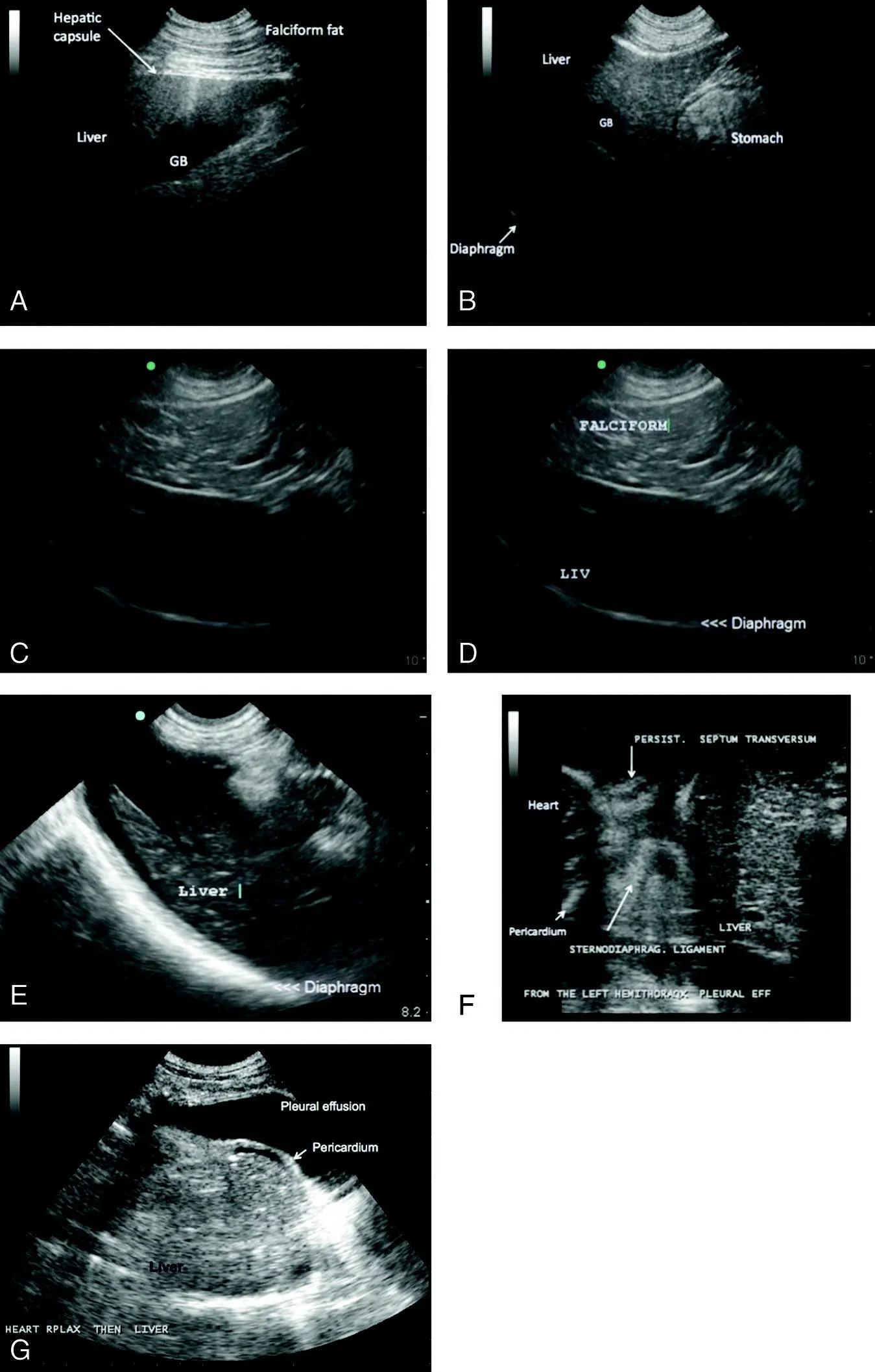Figure 82 Liver margination and comparative echogenicity to the falciform - фото 95