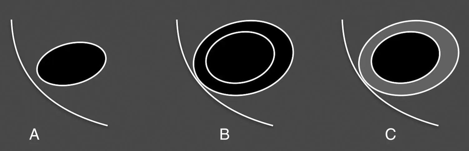 Figure 710 Normal and edematous gallbladder wall and sonographic striation - фото 88