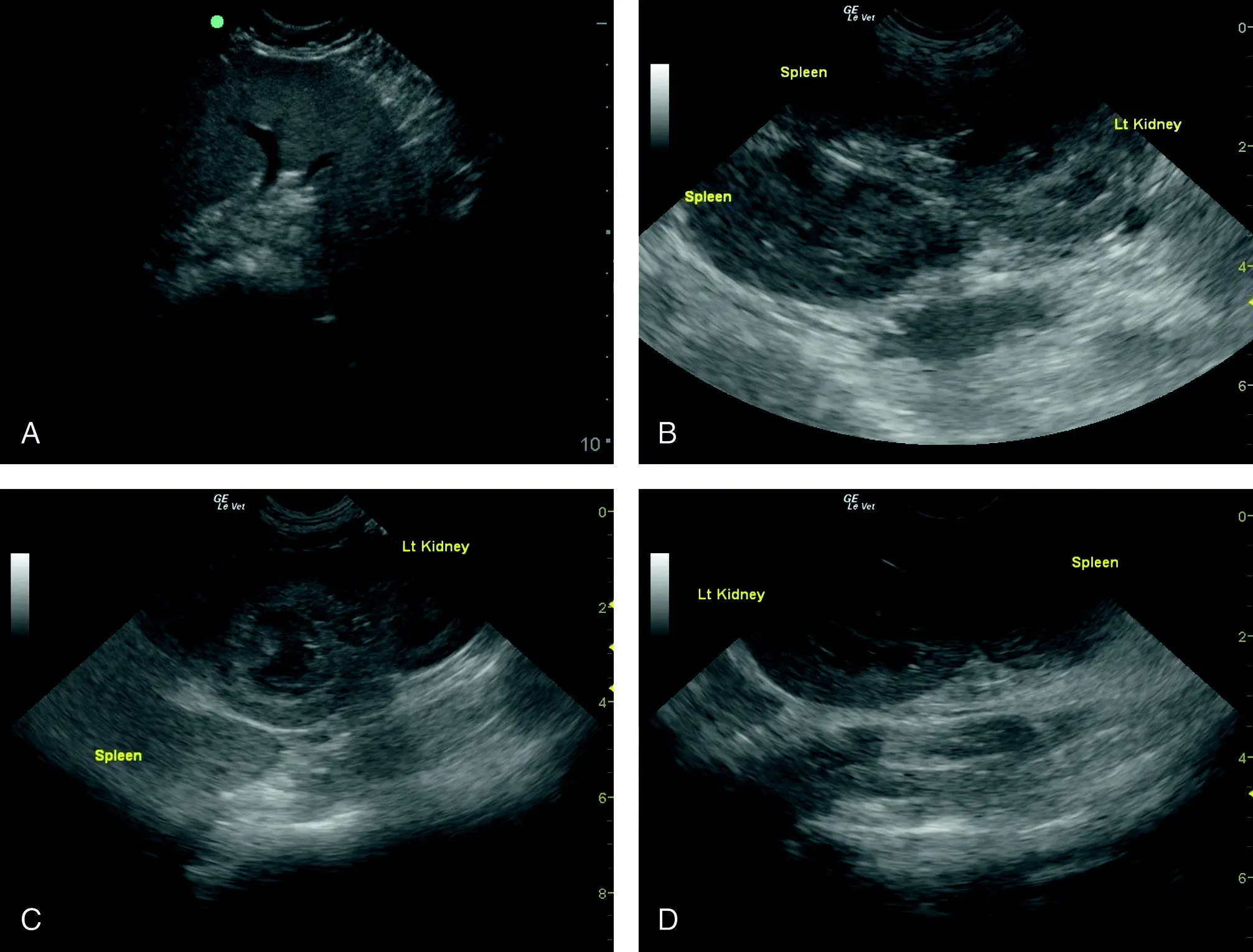 Figure 95 Splenomegaly A Splenomegaly or splenic enlargement as evidenced - фото 105