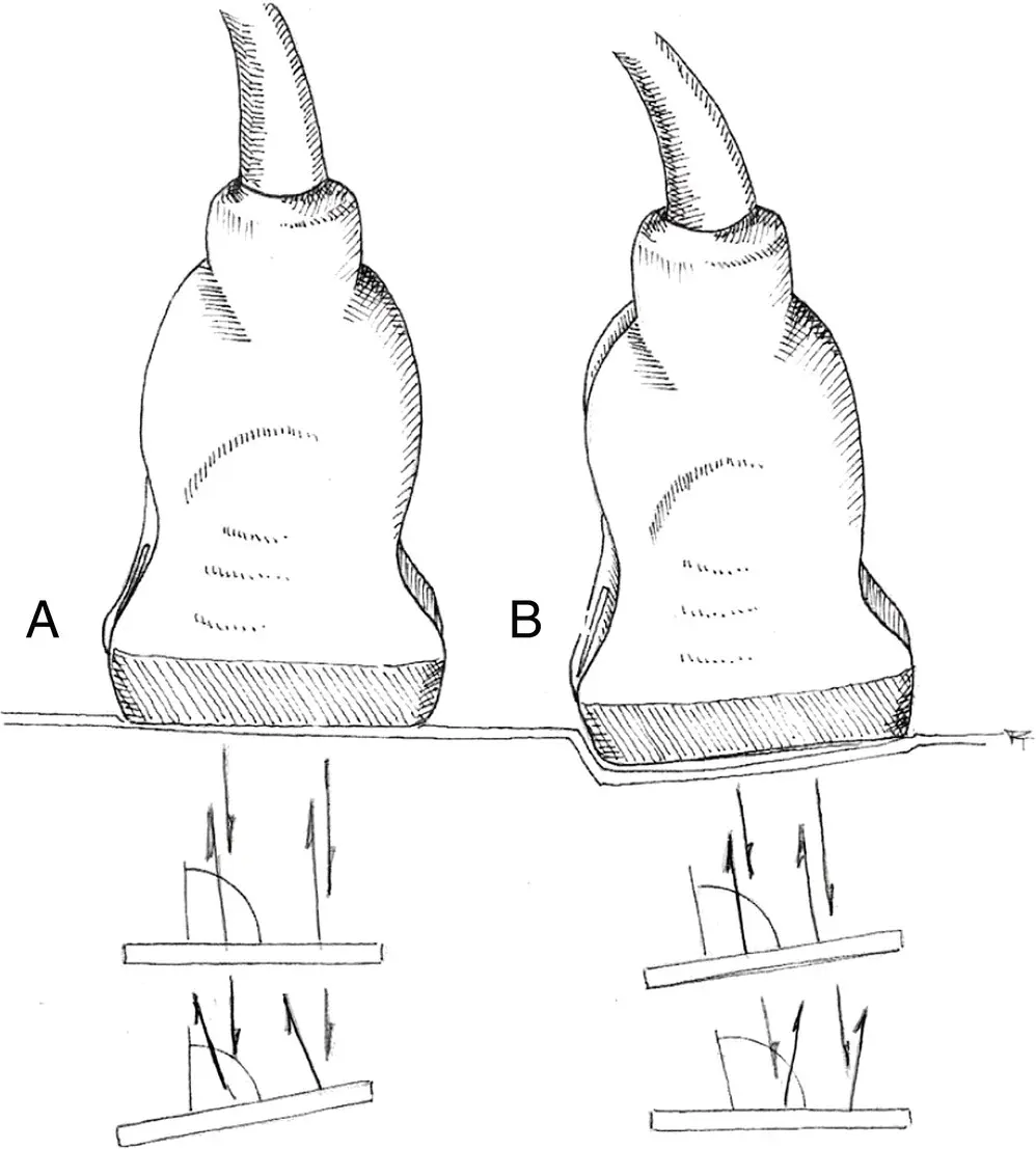 Figure 45 Angle of insonation The angle at which the ultrasound beams - фото 26