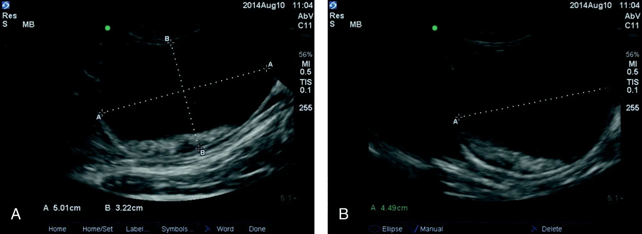 Figure 715 Measurements at the AFAST CC view for estimating urinary bladder - фото 93