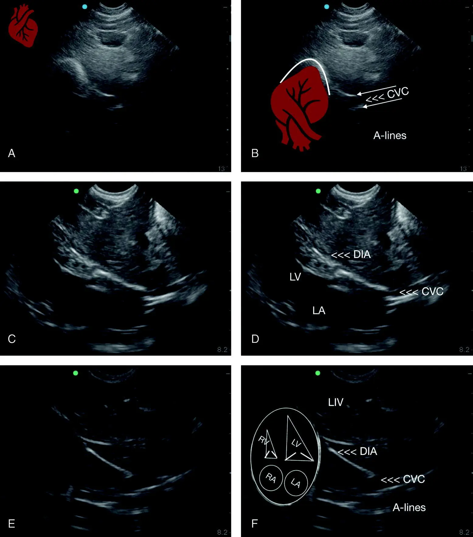 Figure 611 The cardiac bump at the DH view In A the apex of the heart is - фото 58