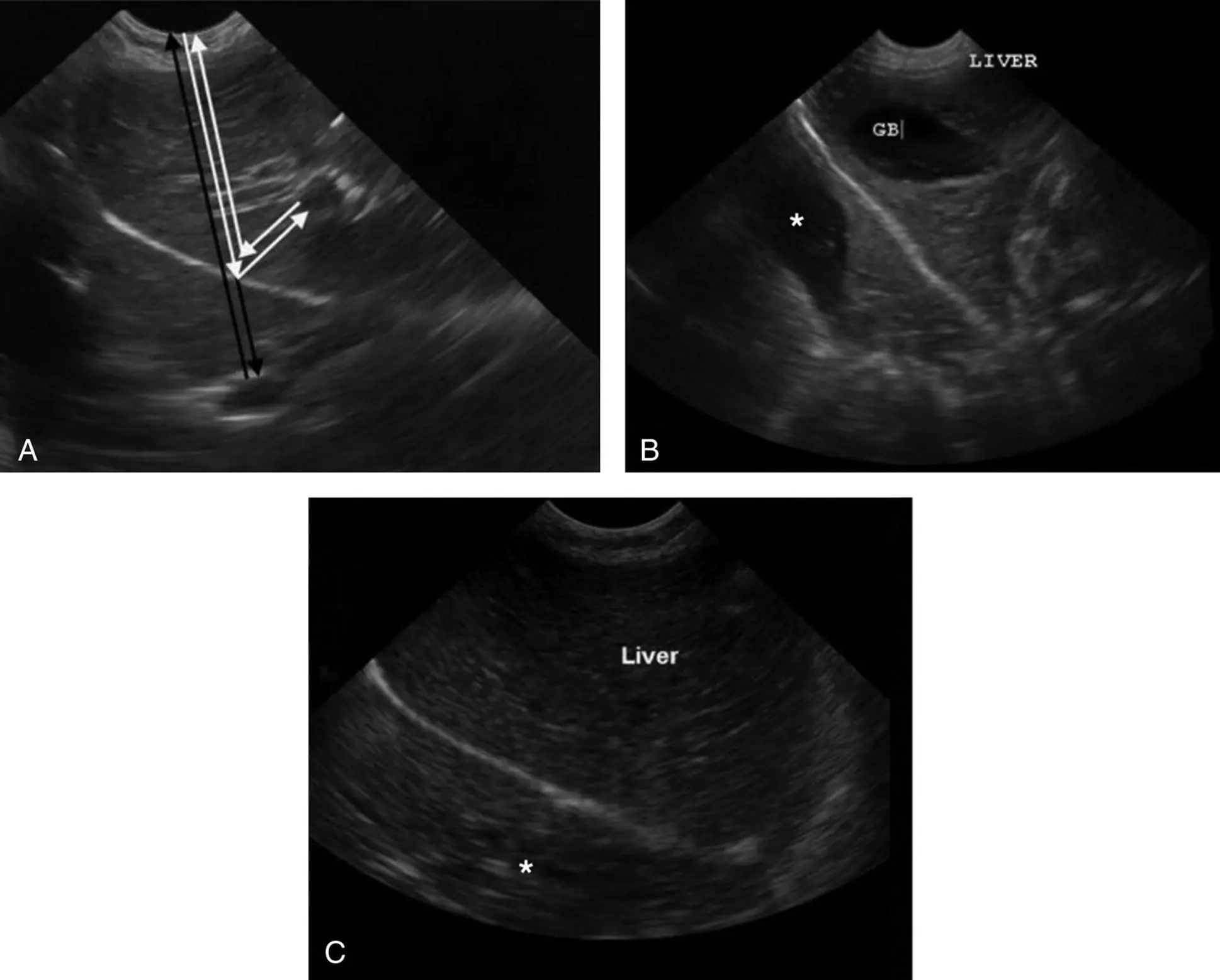Figure 34Mirror artifact The gallbladder appearing to be on both sides of - фото 18