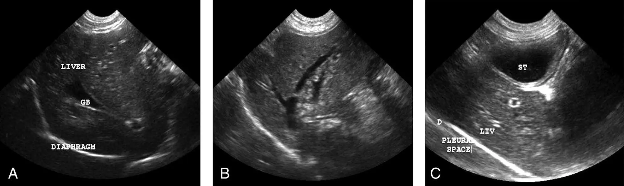 Figure 615 Pitfalls at the DH view related to the gallbladder hepatic venous - фото 62