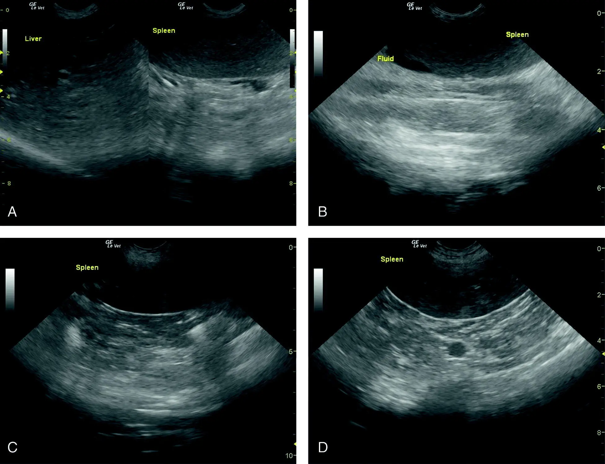 Figure 98 Splenomegaly with splenic hyperechogenicity brighter than normal - фото 108