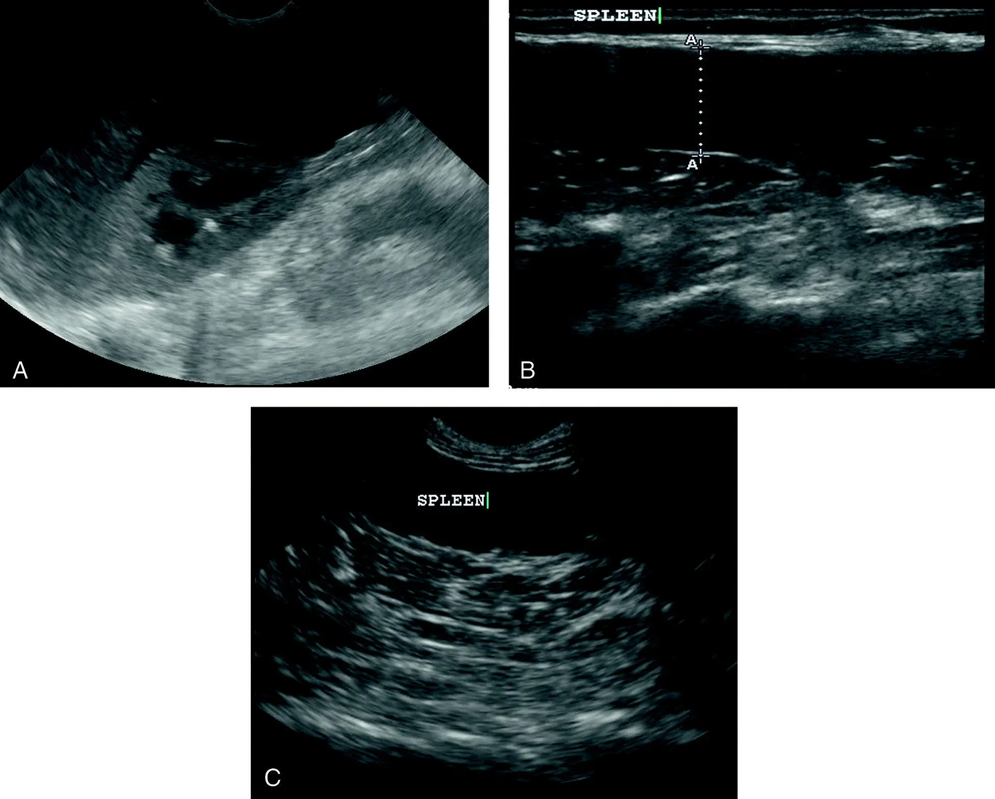 Figure 99 Splenomegaly with splenic hypoechogenicity darker than normal - фото 109